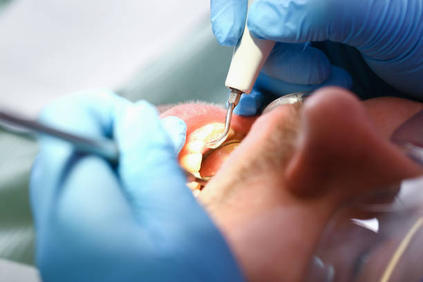 Best Emergency Tooth Extraction in Lake Geneva, WI